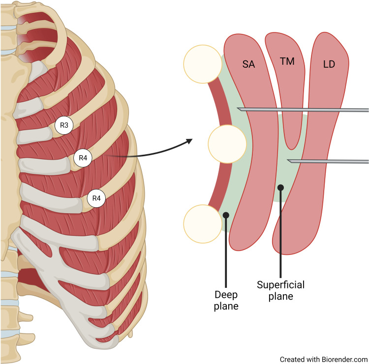 A Review on the Management of Peripheral Neuropathic Pain Following Breast Cancer.