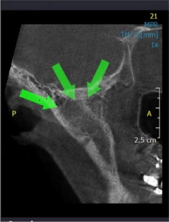 Assessment of bony changes in temporomandibular joint in patients using cone beam computed tomography - a cross sectional study.