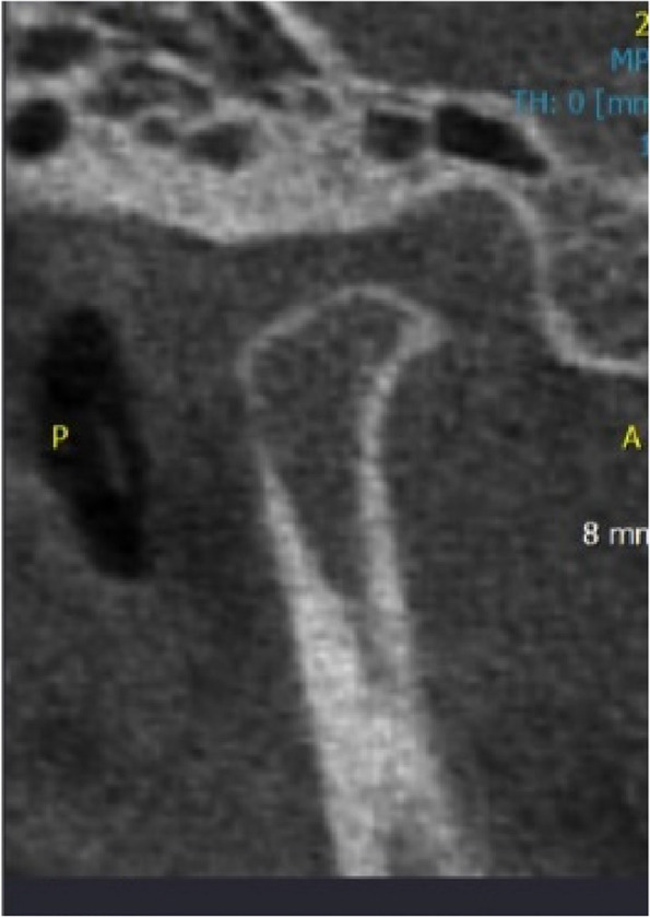 Assessment of bony changes in temporomandibular joint in patients using cone beam computed tomography - a cross sectional study.