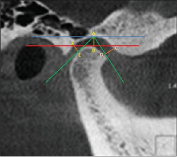 Assessment of bony changes in temporomandibular joint in patients using cone beam computed tomography - a cross sectional study.