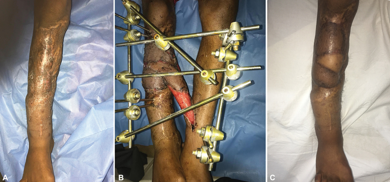 Reliability and Safety of Cross-Leg Free Latissmus Dorsi Muscle Flap in Reconstruction of Mutilating Leg Injuries Using End-to-Side Anastomosis.