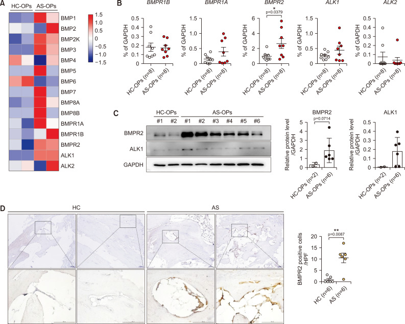 Elevated BMPR2 expression amplifies osteoblast differentiation in ankylosing spondylitis.