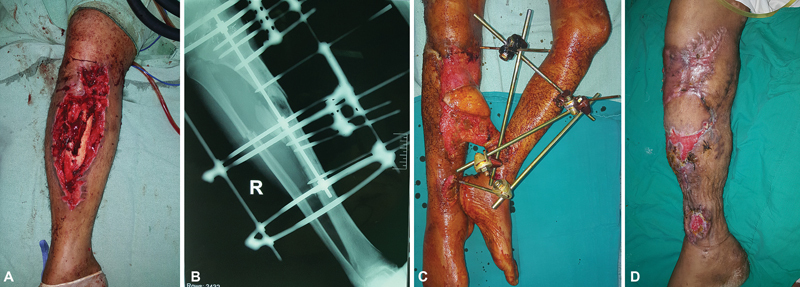 Reliability and Safety of Cross-Leg Free Latissmus Dorsi Muscle Flap in Reconstruction of Mutilating Leg Injuries Using End-to-Side Anastomosis.