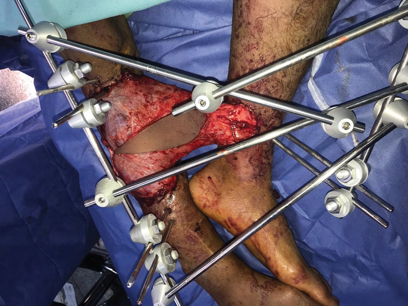 Reliability and Safety of Cross-Leg Free Latissmus Dorsi Muscle Flap in Reconstruction of Mutilating Leg Injuries Using End-to-Side Anastomosis.