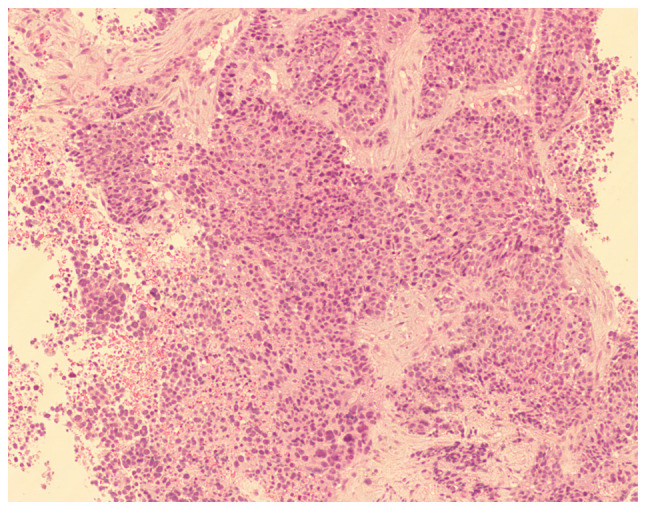 Multiple synchronous primary malignant neoplasms: A case report and literature review.