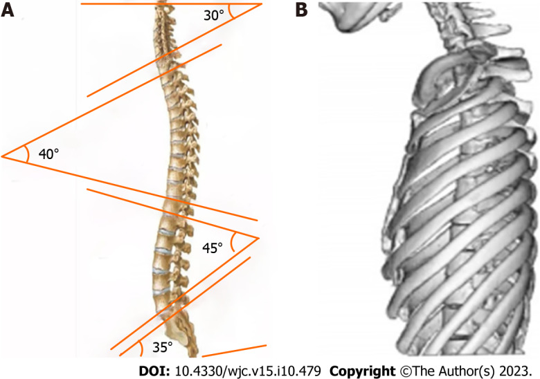 Related mechanisms and research progress in straight back syndrome.