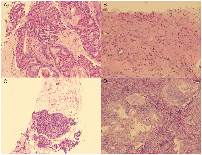 Multiple synchronous primary malignant neoplasms: A case report and literature review.