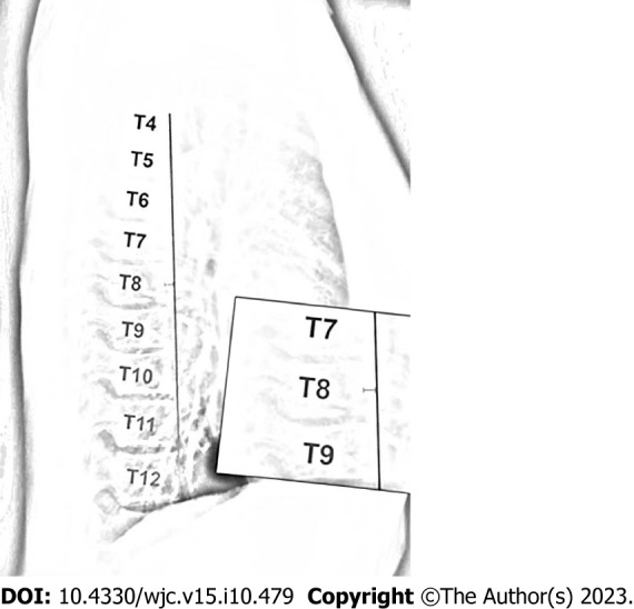 Related mechanisms and research progress in straight back syndrome.