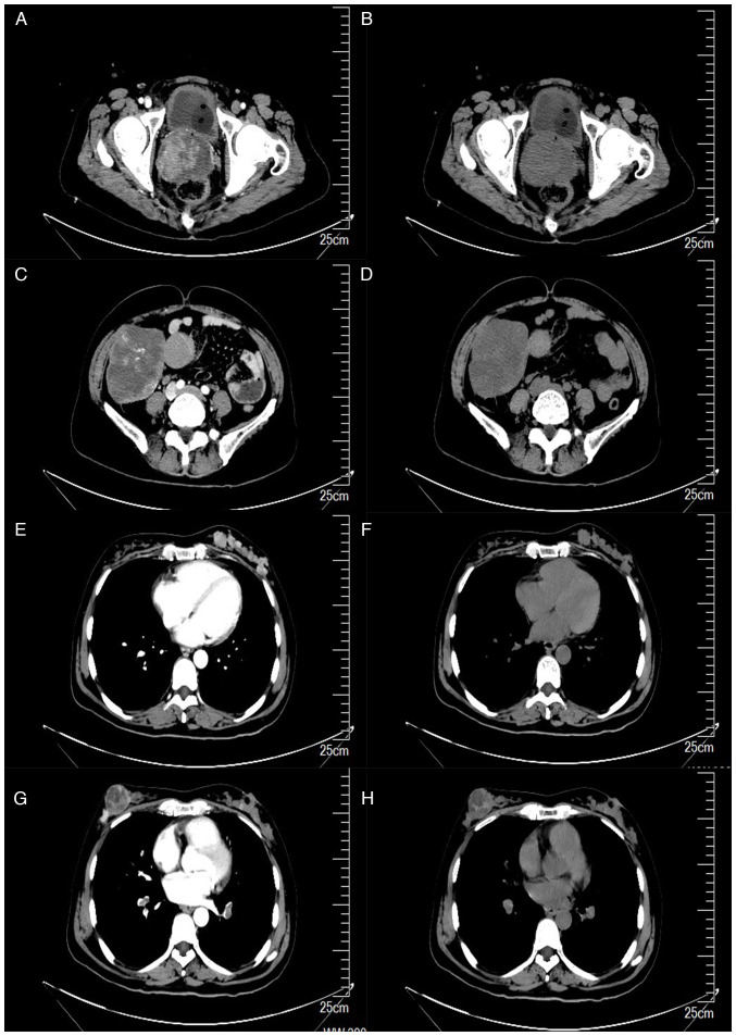 Multiple synchronous primary malignant neoplasms: A case report and literature review.