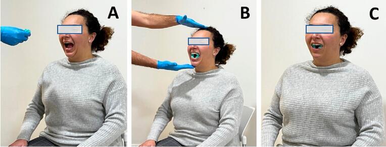 Test-retest reliability of the isometric contraction test (IC test) of the masticatory muscles in subjects with and without temporomandibular muscle disorders.