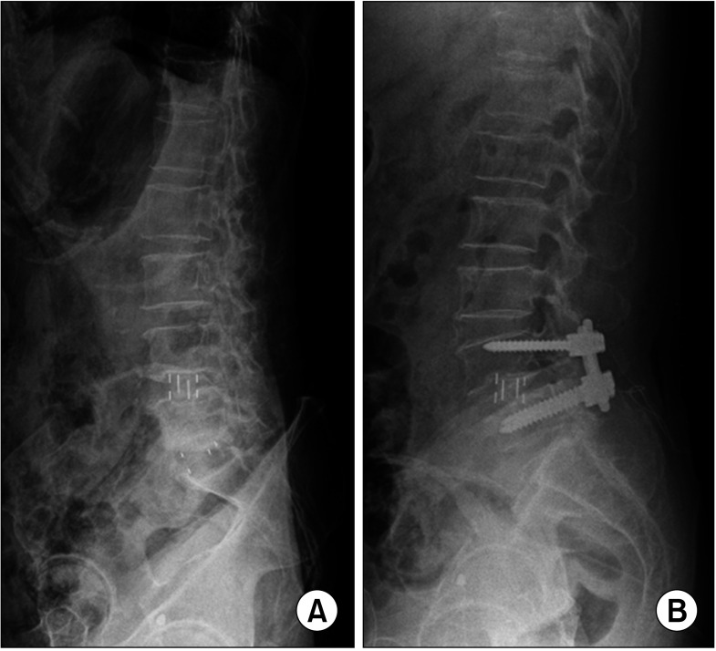 Predictors of Vertebral Endplate Fractures after Oblique Lumbar Interbody Fusion.