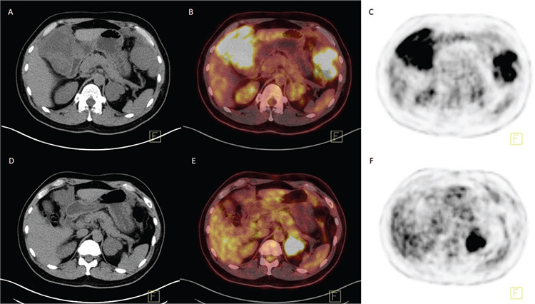 Alterations in <sup>18</sup>F-FDG Uptake Patterns may Limit Cross-sectional Evaluation of Adrenal Adenomas Using Single <sup>18</sup>F-FDG PET/CT Imaging.