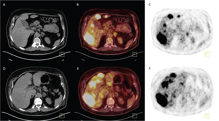 Alterations in <sup>18</sup>F-FDG Uptake Patterns may Limit Cross-sectional Evaluation of Adrenal Adenomas Using Single <sup>18</sup>F-FDG PET/CT Imaging.