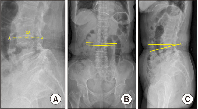 Predictors of Vertebral Endplate Fractures after Oblique Lumbar Interbody Fusion.