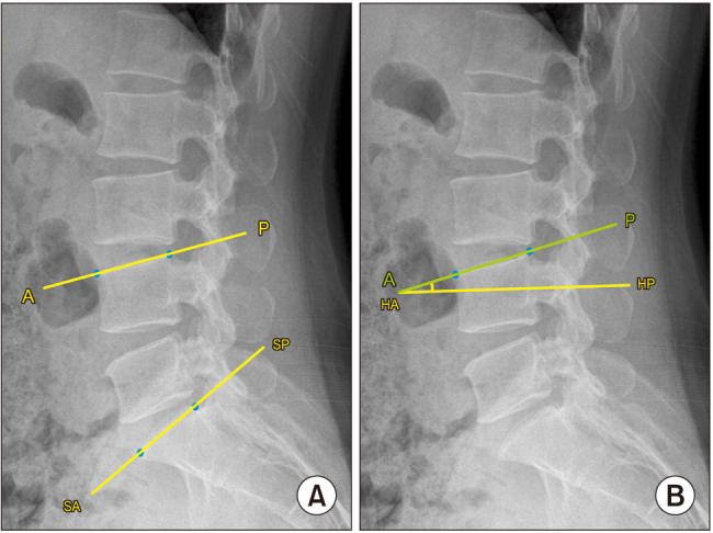 Predictors of Vertebral Endplate Fractures after Oblique Lumbar Interbody Fusion.