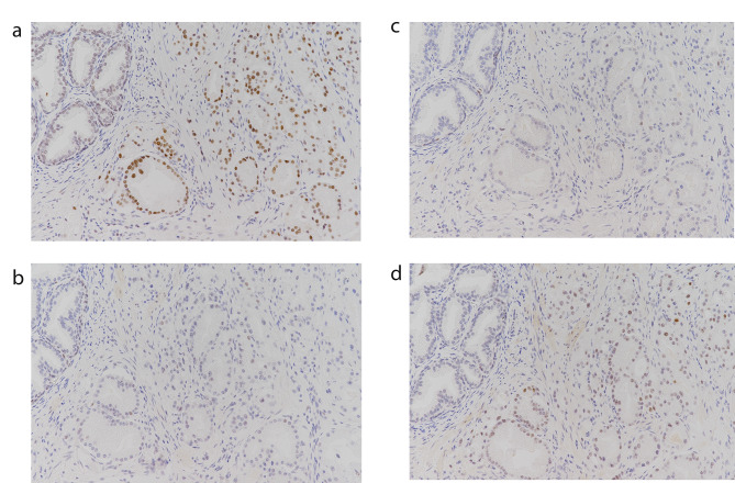 The prevalence of lynch syndrome (DNA mismatch repair protein deficiency) in patients with primary localized prostate cancer using immunohistochemistry screening.