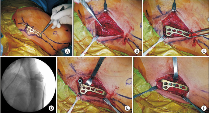 Clinical Outcome after Clavicular Hook Plate Fixation for Displaced Medial-End Clavicle Fractures.