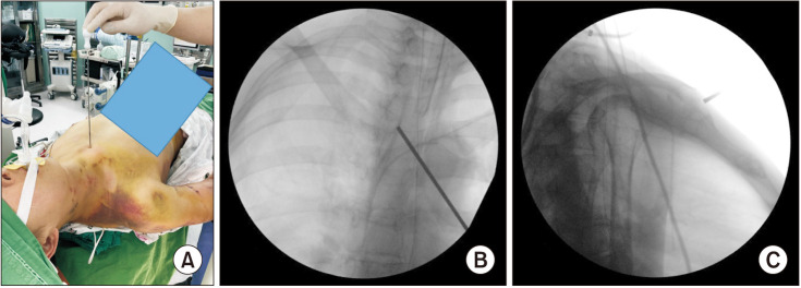 Clinical Outcome after Clavicular Hook Plate Fixation for Displaced Medial-End Clavicle Fractures.