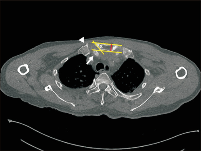 Clinical Outcome after Clavicular Hook Plate Fixation for Displaced Medial-End Clavicle Fractures.