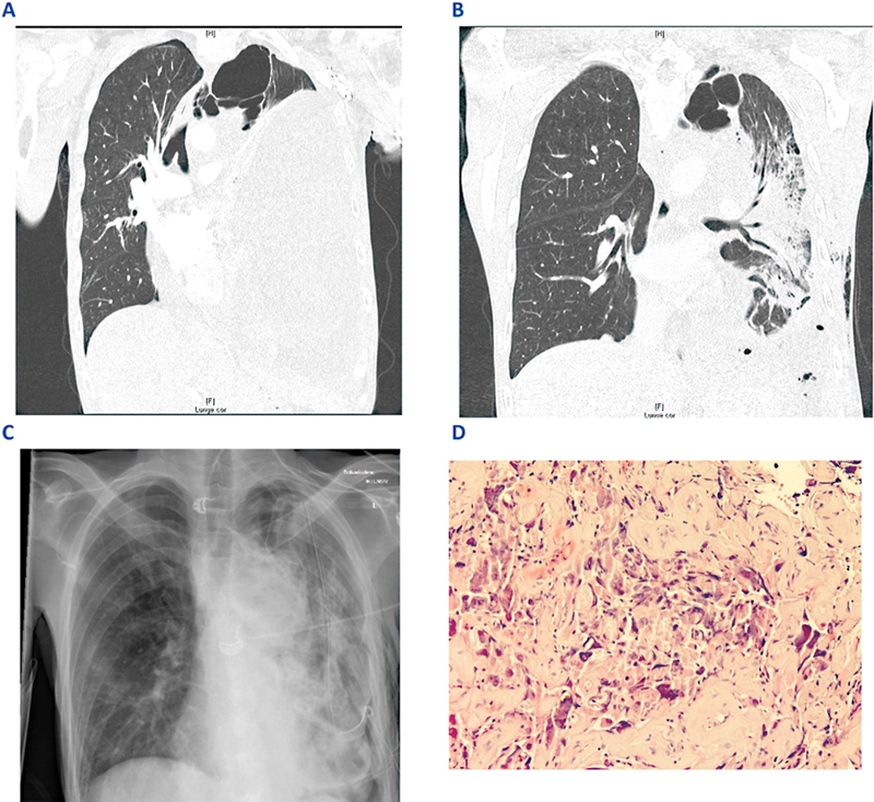 Awake Uniportal VATS for the Evacuation of an Extensive, Superinfected Hemothorax in a Patient with Advanced Mediastinal SMARCA4-Deficient Tumor.