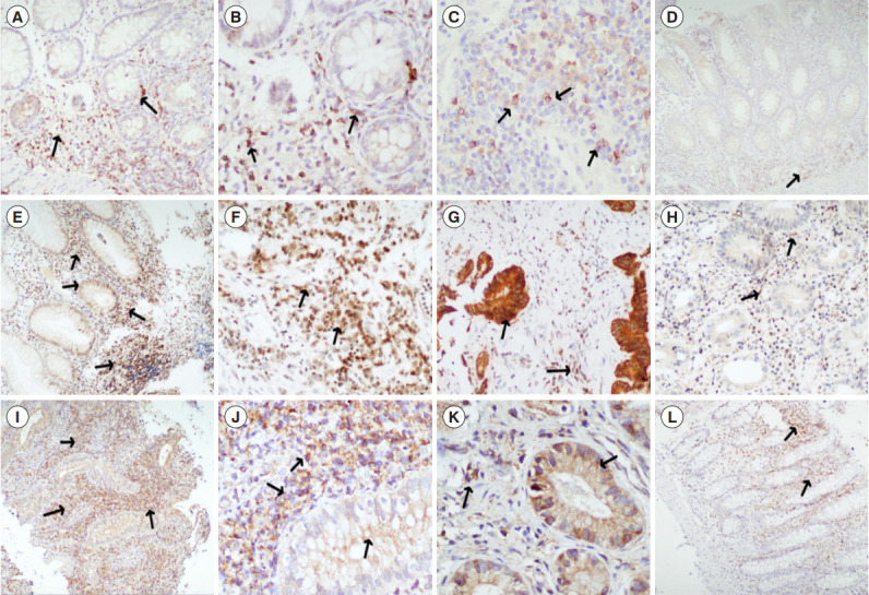 Serum albumin is the strongest predictor of anti-tumor necrosis factor nonresponse in inflammatory bowel disease in resource-constrained regions lacking therapeutic drug monitoring.