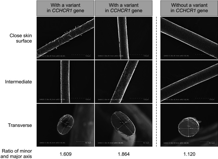 Clinical Findings, Response to Steroid Treatment, and Recurrence Rate in Alopecia Areata Patients with or without a Nonsynonymous Variant of Coiled-Coil Alpha-Helical Rod Protein 1.