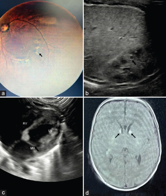 How early is too early? Diagnosis of tuberous sclerosis complex in a neonate.