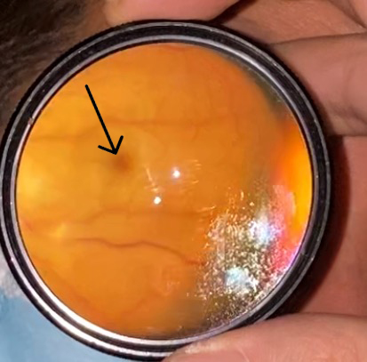 Sonographic Retrobulbar Spot Sign in Diagnosis of Central Retinal Artery Occlusion: A Case Report.