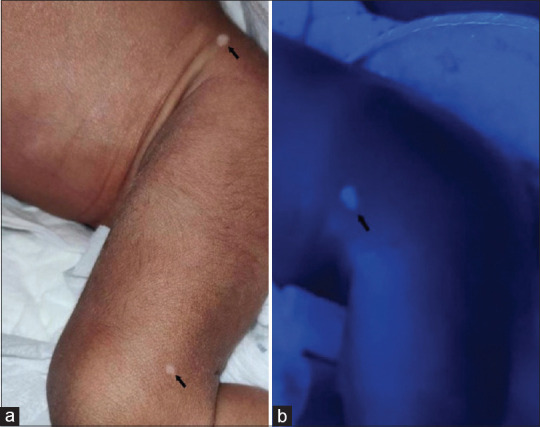 How early is too early? Diagnosis of tuberous sclerosis complex in a neonate.