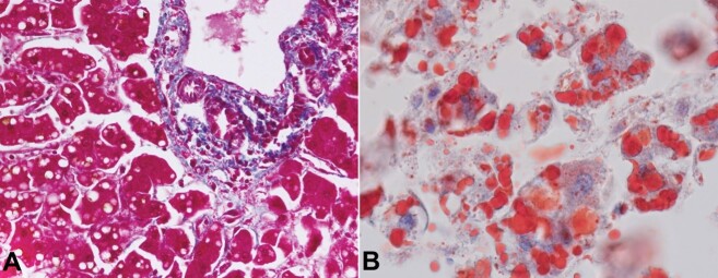 Alcoholic foamy degeneration: an unusual presentation of the alcoholic liver disease diagnosed on autopsy.