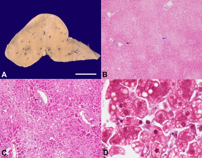 Alcoholic foamy degeneration: an unusual presentation of the alcoholic liver disease diagnosed on autopsy.