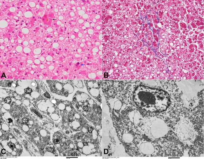Alcoholic foamy degeneration: an unusual presentation of the alcoholic liver disease diagnosed on autopsy.