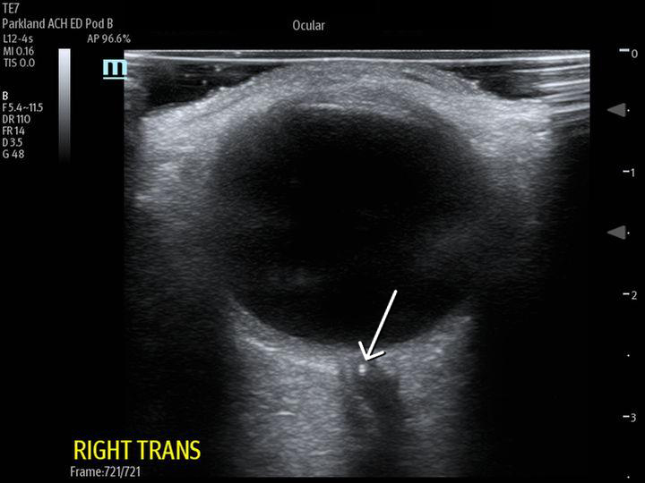 Sonographic Retrobulbar Spot Sign in Diagnosis of Central Retinal Artery Occlusion: A Case Report.