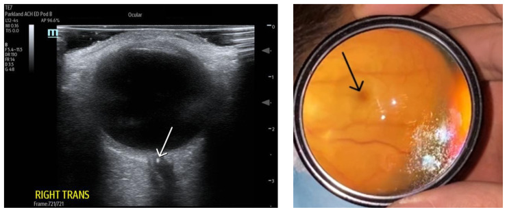 Sonographic Retrobulbar Spot Sign in Diagnosis of Central Retinal Artery Occlusion: A Case Report.