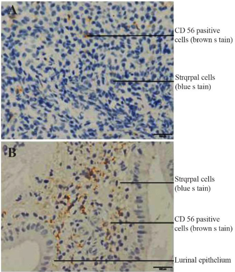 Establishment of Cut-off Values for Uterine and Peripheral Blood Natural Killer Cells During the Peri-implantation Period in Fertile Controls and Women with Unexplained Recurrent Implantation Failure.