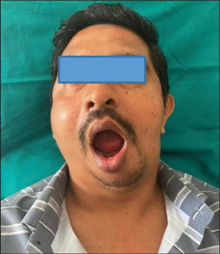 Diagnostic Imageology of Goldenhar Syndrome: Report of a Rare Case.