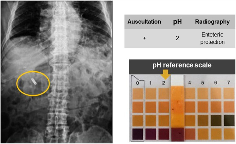 Agreement Between Epigastric Auscultation and pH Measurement in the Confirmation of Nasoenteral Tube Placement.
