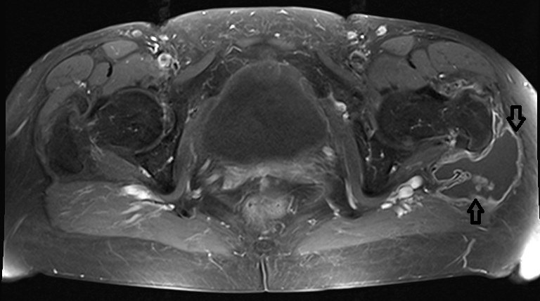Localized pigmented villo-nodular synovitis of trochanteric bursa.