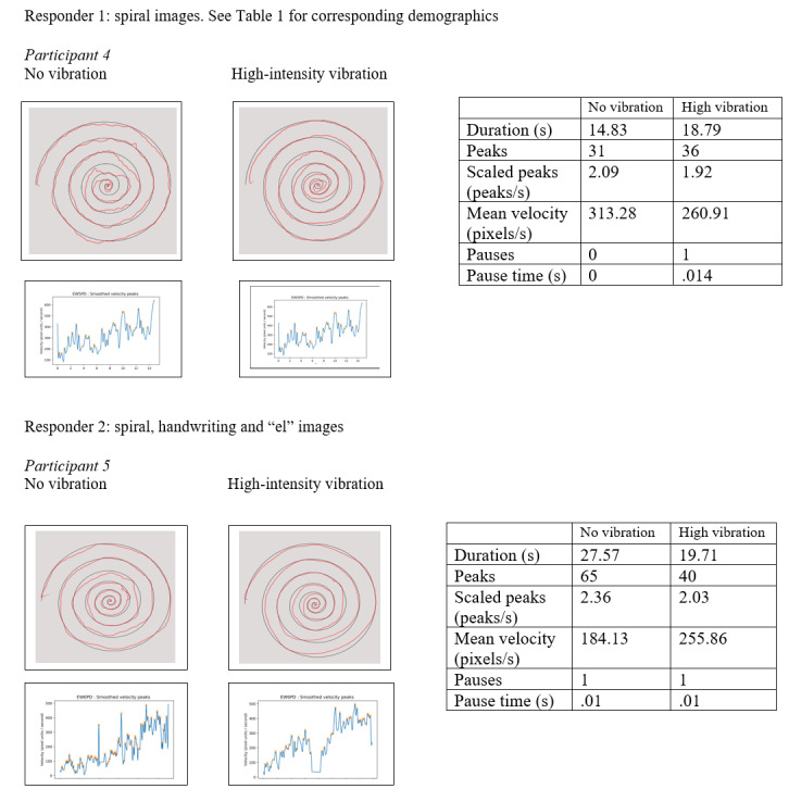 A Wearable Vibratory Device (The Emma Watch) to Address Action Tremor in Parkinson Disease: Pilot Feasibility Study.