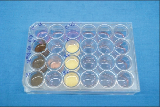Effect of different concentrations of titanium and silver nanoparticles on maxillofacial silicone MDX4-4210 on cell viability, tear bond strength, and shore strength: An <i>in vitro</i> study.