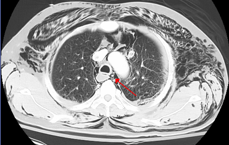 A clinical review of spontaneous pneumomediastinum.