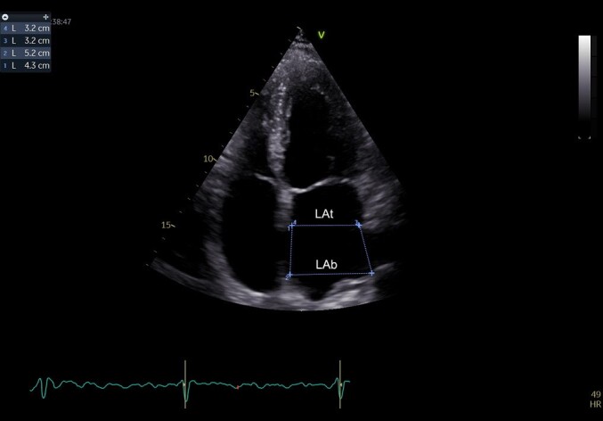 Factors Associated with Stroke in Atrial Fibrillation. A Retrospective Study.