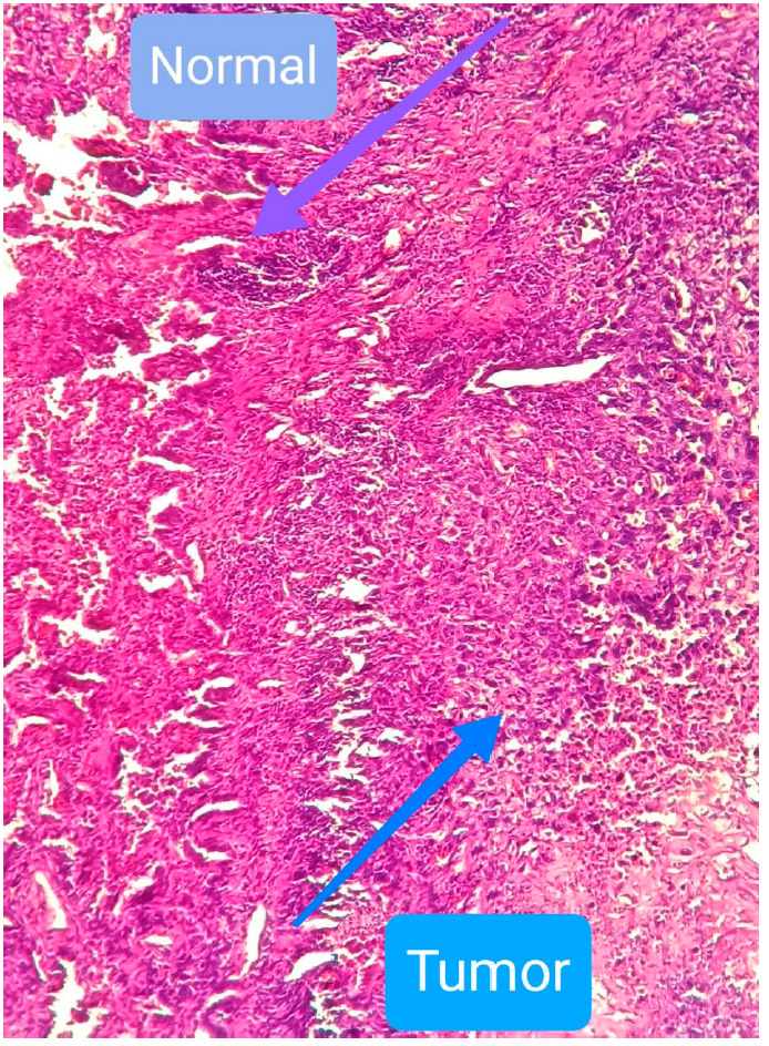 Membrane Partitioning of TEMPO Discriminates Human Lung Cancer from Neighboring Normal Cells.