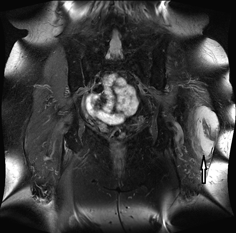 Localized pigmented villo-nodular synovitis of trochanteric bursa.