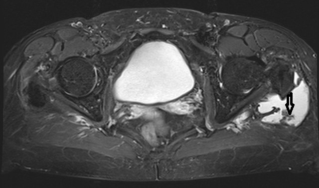 Localized pigmented villo-nodular synovitis of trochanteric bursa.