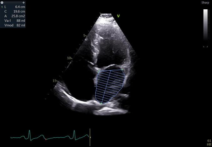 Factors Associated with Stroke in Atrial Fibrillation. A Retrospective Study.