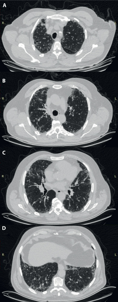 Moldy Hazelnut Husk and Shell Related Hypersensitivity Pneumonitis: A Possible Novel Occupational Causative Agent.