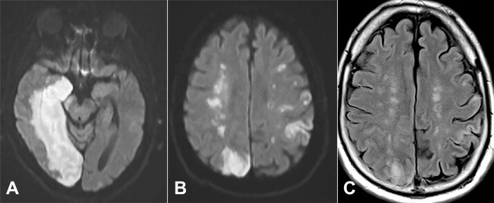 Radiologic-pathologic autopsy correlation of an internal watershed infarct, a case report.