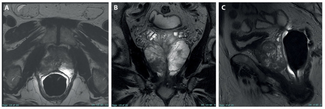 Granulomatous prostatitis: mimicking locally advanced prostate adenocarcinoma.