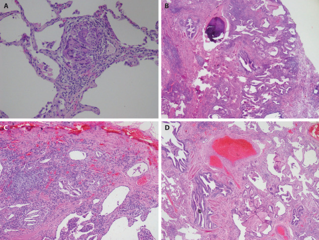 Moldy Hazelnut Husk and Shell Related Hypersensitivity Pneumonitis: A Possible Novel Occupational Causative Agent.